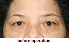 plastic-surgery-blepharoplasty